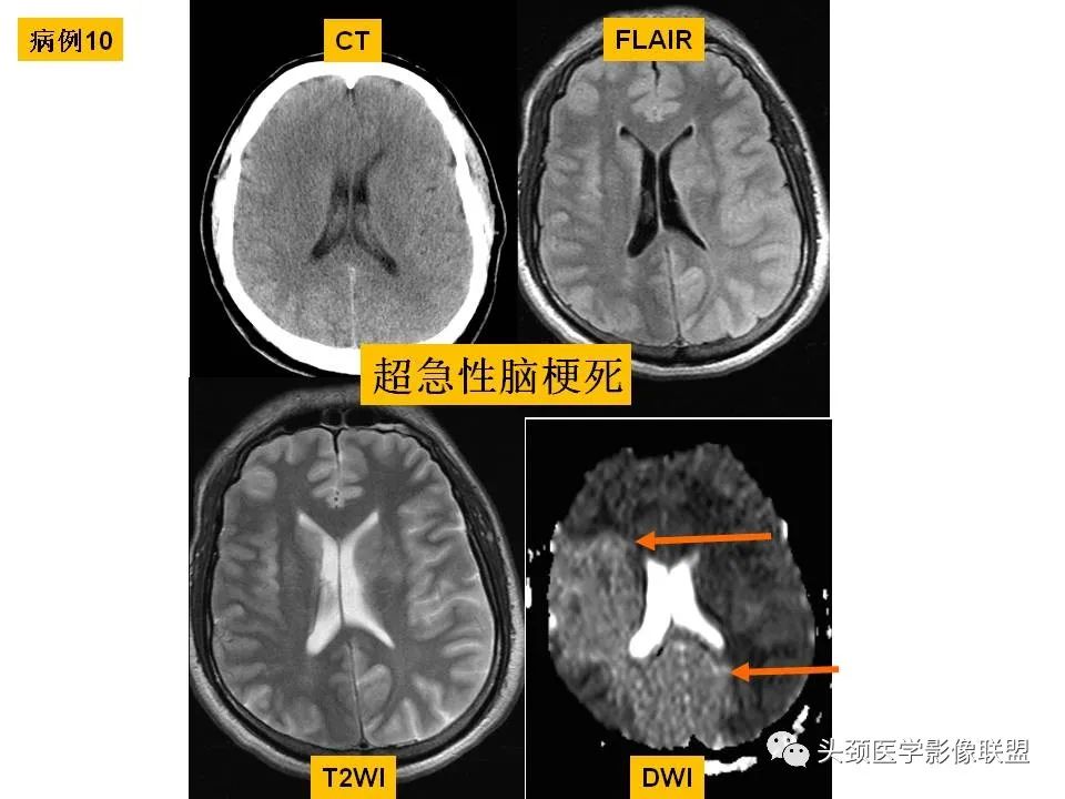 影像PPT - 【PPT】颅脑解剖及血管性病变的MRI诊断-55