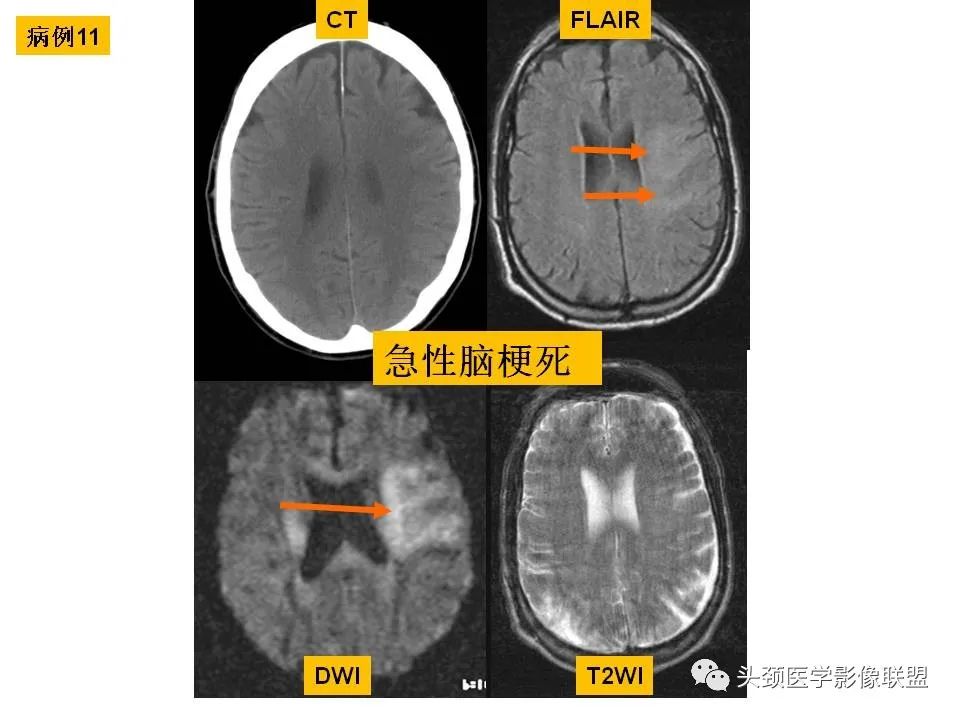影像PPT - 【PPT】颅脑解剖及血管性病变的MRI诊断-56