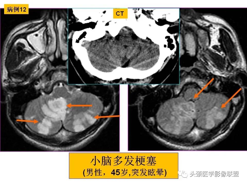 影像PPT - 【PPT】颅脑解剖及血管性病变的MRI诊断-57