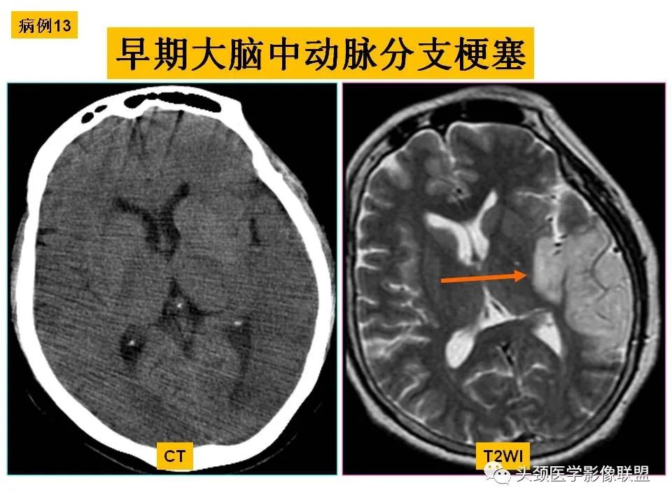 影像PPT - 【PPT】颅脑解剖及血管性病变的MRI诊断-58