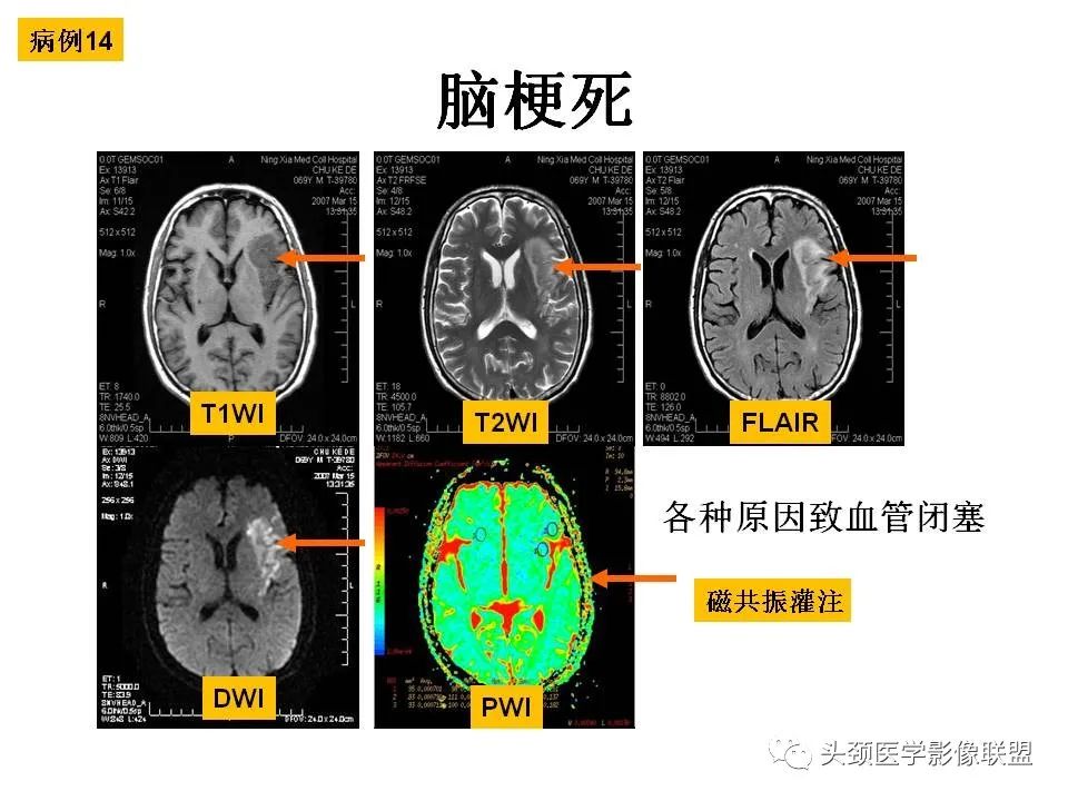 影像PPT - 【PPT】颅脑解剖及血管性病变的MRI诊断-59