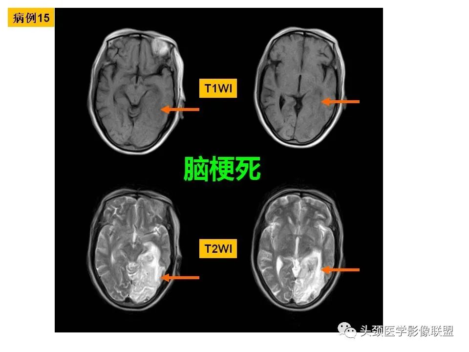 影像PPT - 【PPT】颅脑解剖及血管性病变的MRI诊断-60