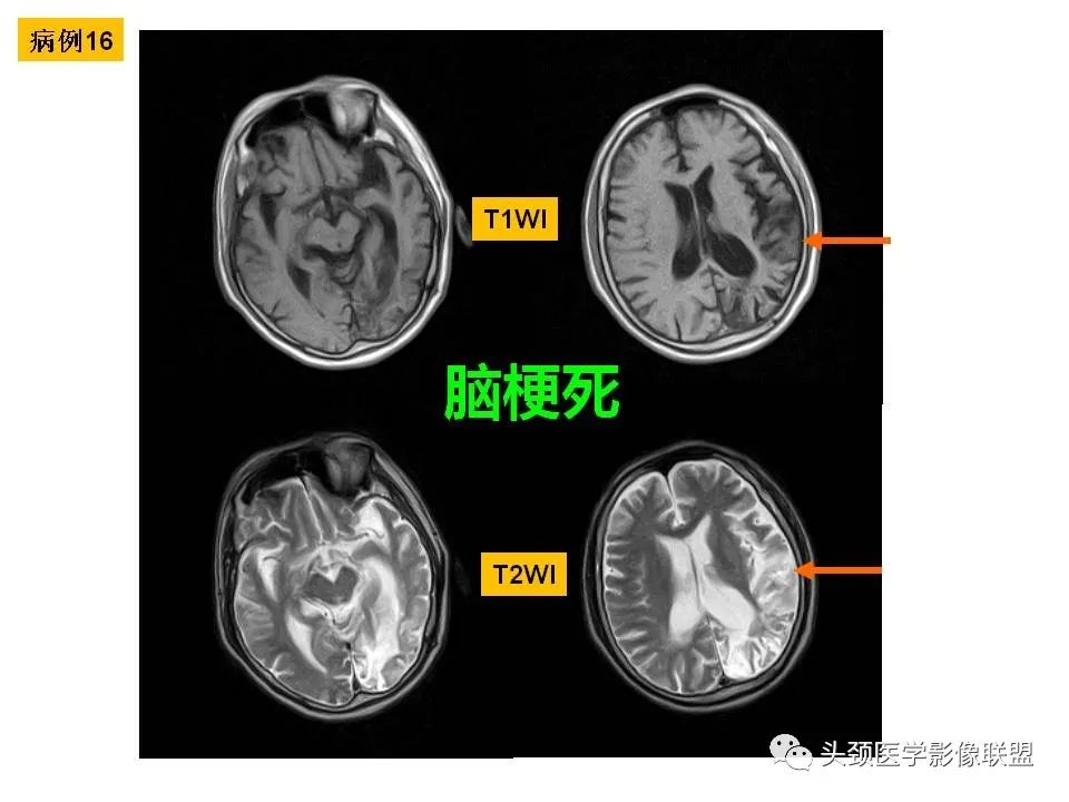 影像PPT - 【PPT】颅脑解剖及血管性病变的MRI诊断-61