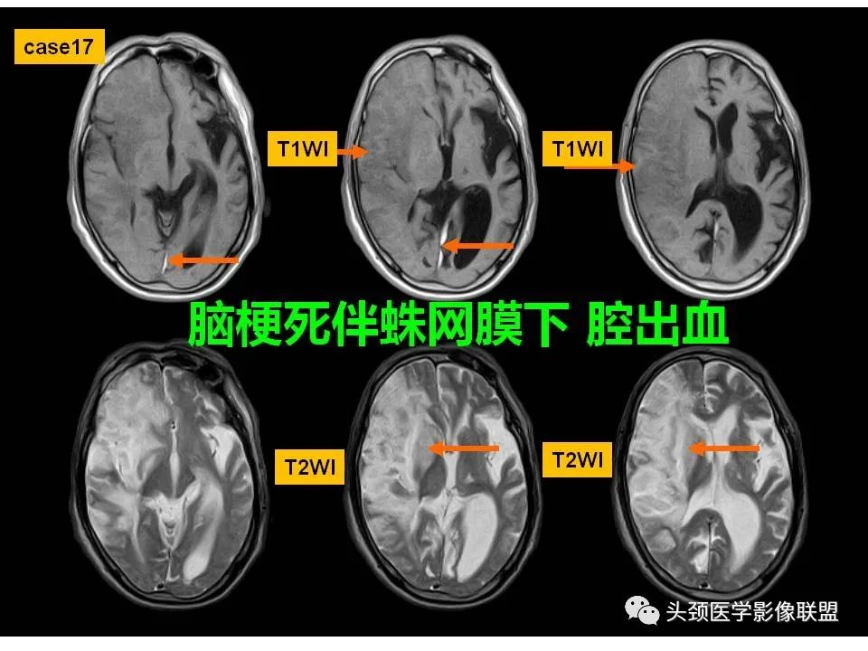 影像PPT - 【PPT】颅脑解剖及血管性病变的MRI诊断-62