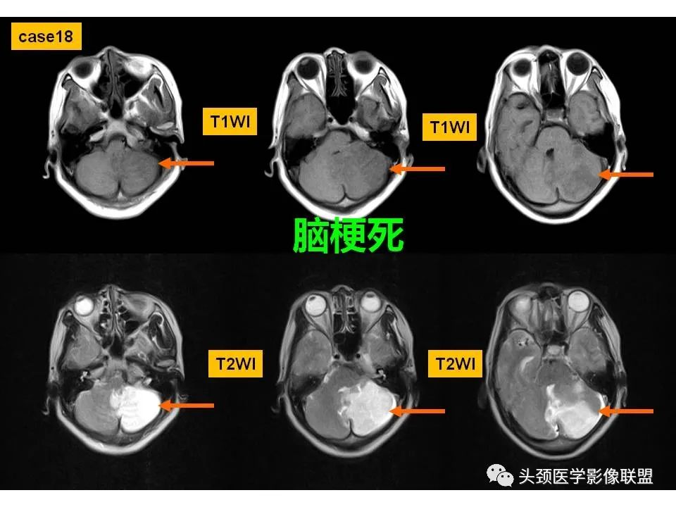 影像PPT - 【PPT】颅脑解剖及血管性病变的MRI诊断-63