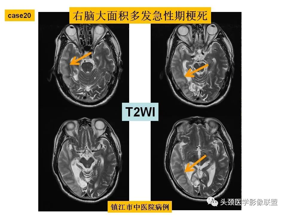 影像PPT - 【PPT】颅脑解剖及血管性病变的MRI诊断-66
