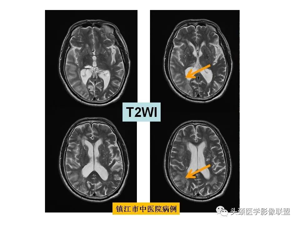 影像PPT - 【PPT】颅脑解剖及血管性病变的MRI诊断-67