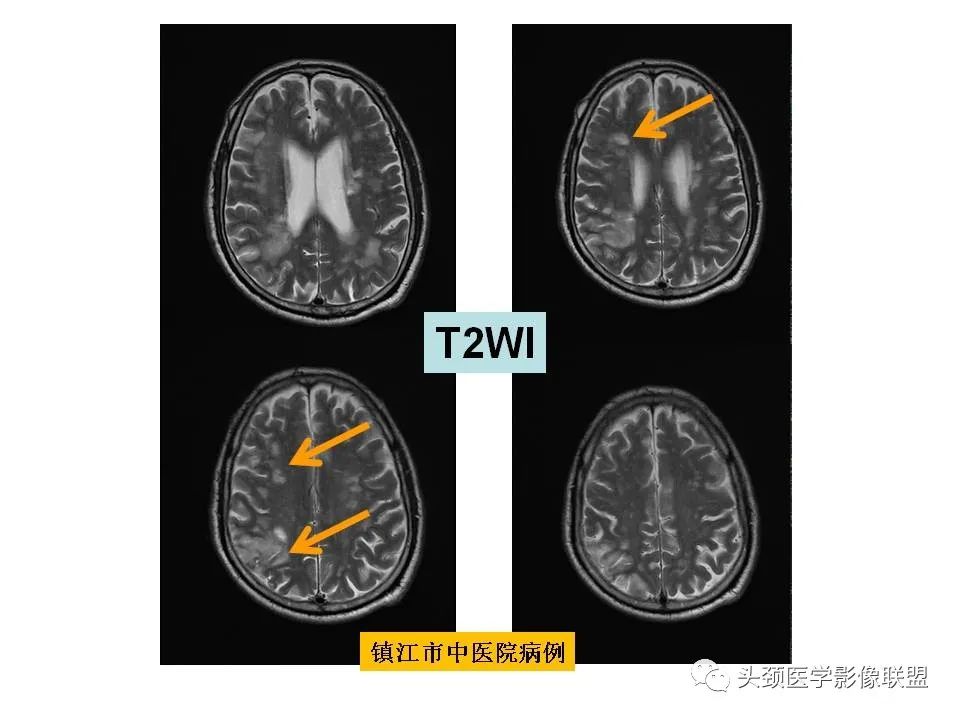 影像PPT - 【PPT】颅脑解剖及血管性病变的MRI诊断-68