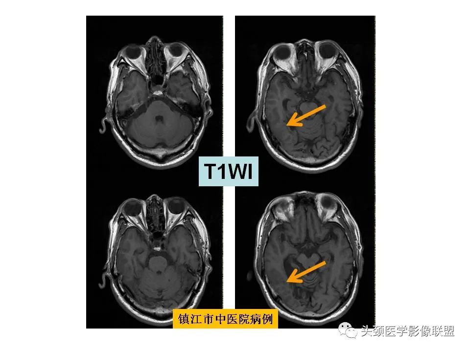 影像PPT - 【PPT】颅脑解剖及血管性病变的MRI诊断-69