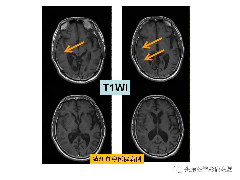 影像PPT - 【PPT】颅脑解剖及血管性病变的MRI诊断-70