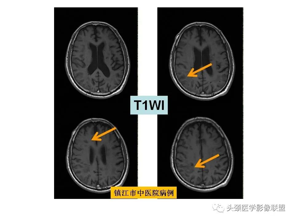 影像PPT - 【PPT】颅脑解剖及血管性病变的MRI诊断-71