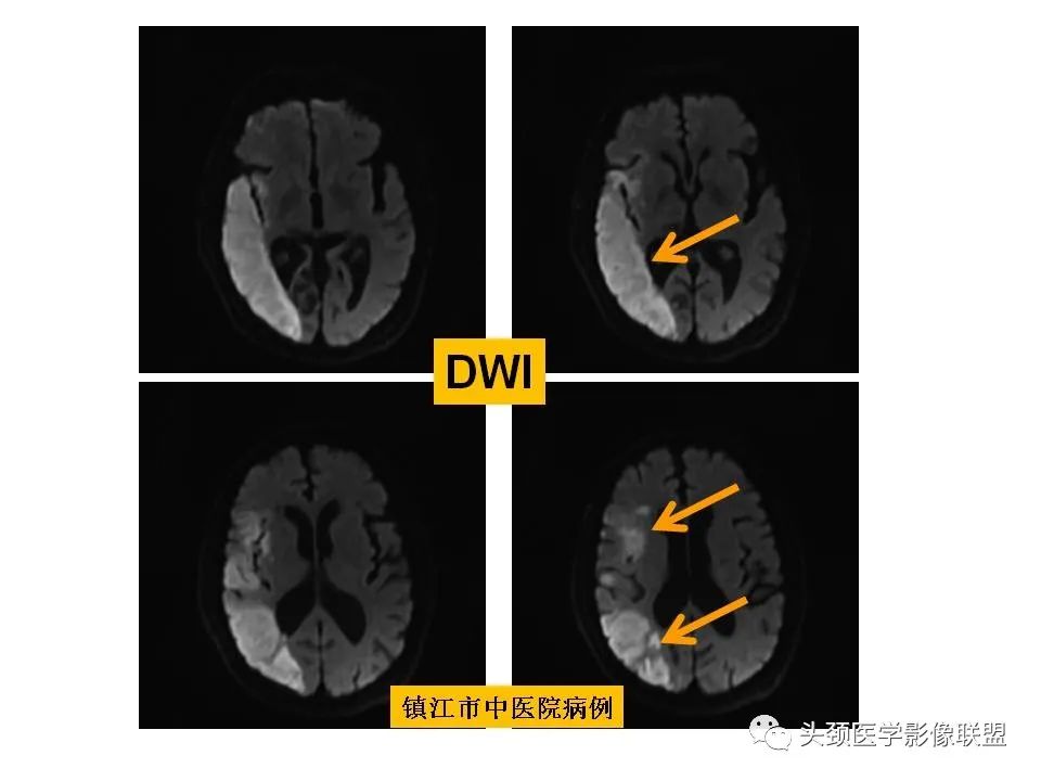 影像PPT - 【PPT】颅脑解剖及血管性病变的MRI诊断-75