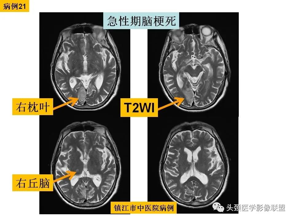 影像PPT - 【PPT】颅脑解剖及血管性病变的MRI诊断-77