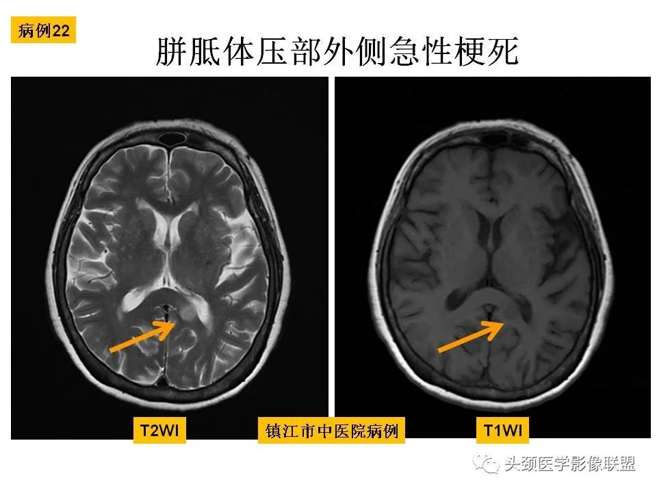 影像PPT - 【PPT】颅脑解剖及血管性病变的MRI诊断-81