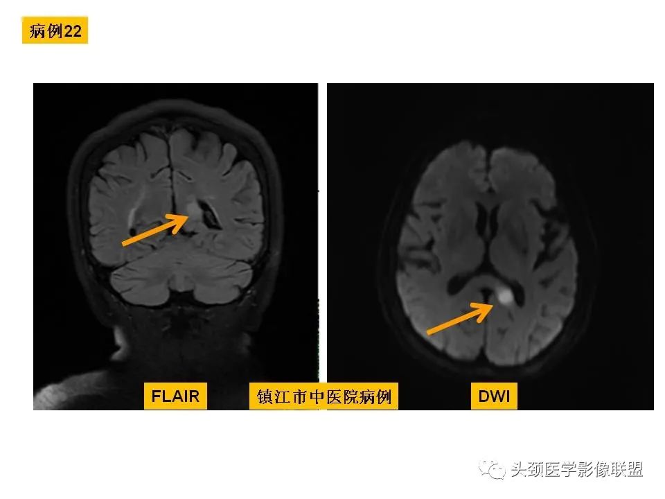 影像PPT - 【PPT】颅脑解剖及血管性病变的MRI诊断-82