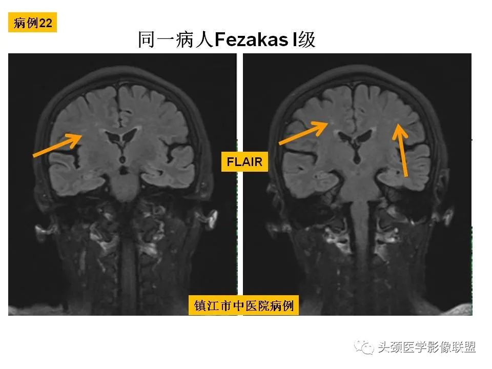 影像PPT - 【PPT】颅脑解剖及血管性病变的MRI诊断-83