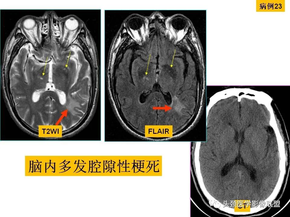 影像PPT - 【PPT】颅脑解剖及血管性病变的MRI诊断-88