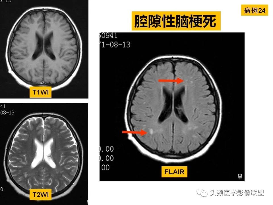 影像PPT - 【PPT】颅脑解剖及血管性病变的MRI诊断-89