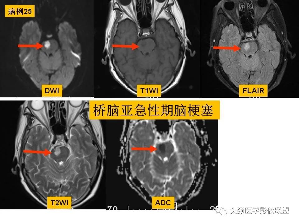 影像PPT - 【PPT】颅脑解剖及血管性病变的MRI诊断-90