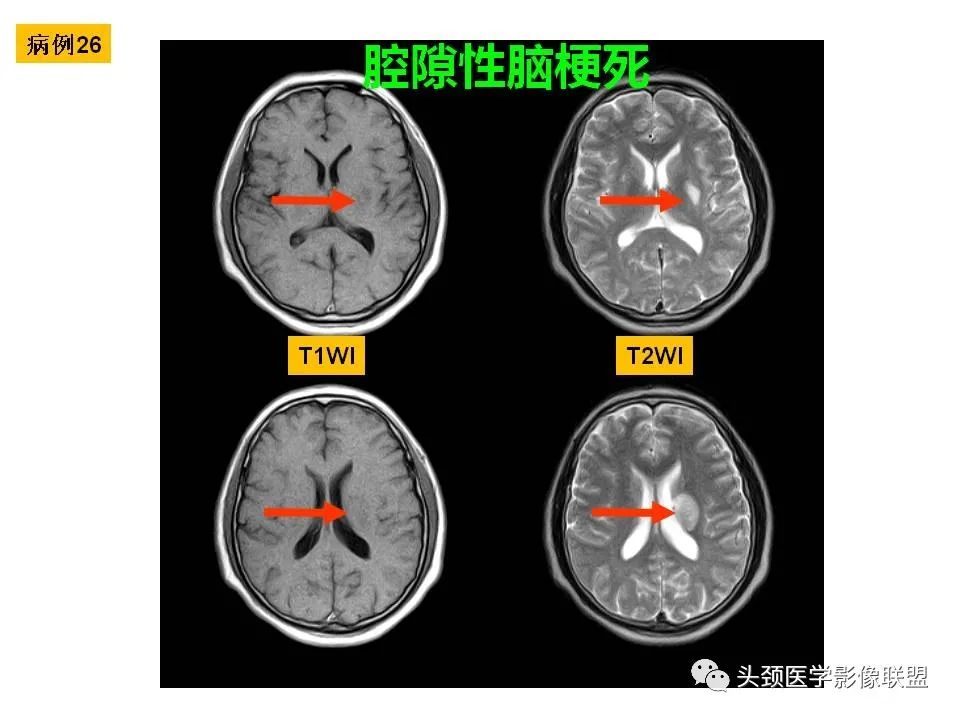 影像PPT - 【PPT】颅脑解剖及血管性病变的MRI诊断-91