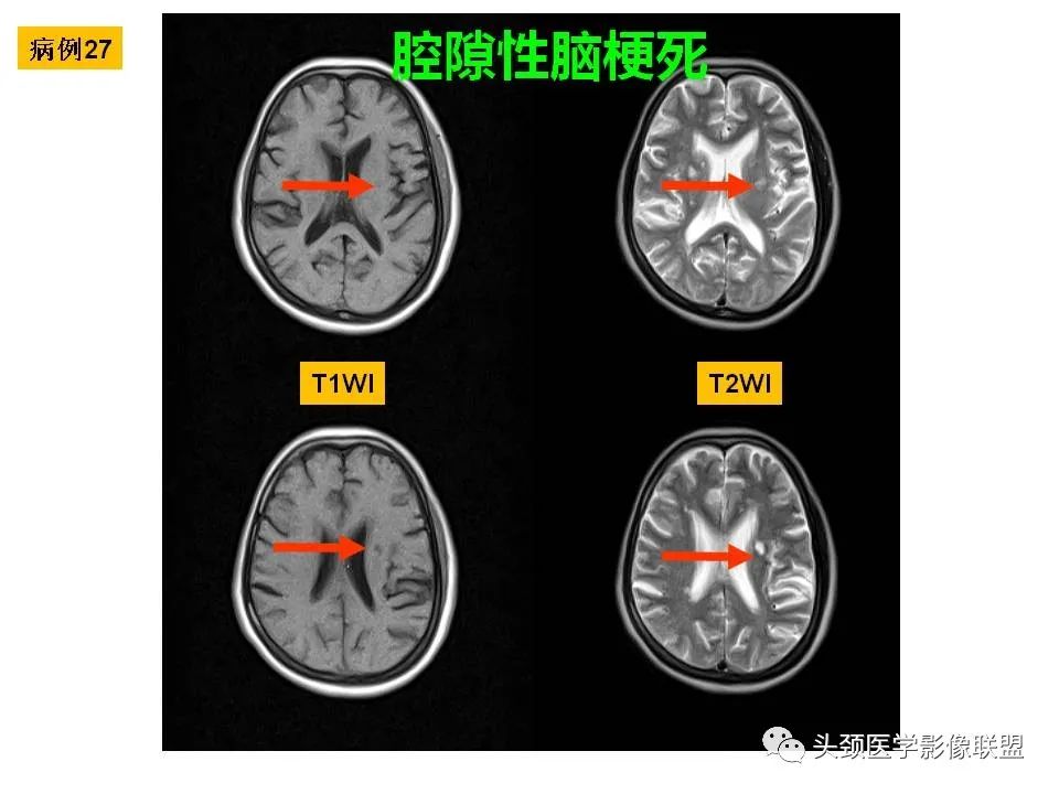 影像PPT - 【PPT】颅脑解剖及血管性病变的MRI诊断-92