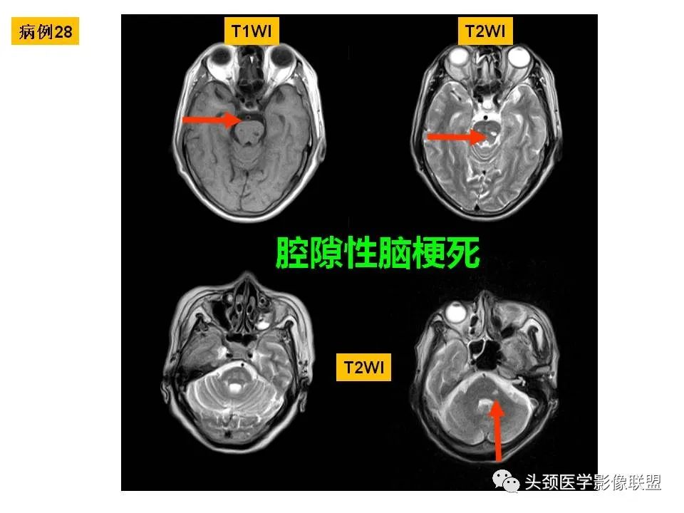 影像PPT - 【PPT】颅脑解剖及血管性病变的MRI诊断-93
