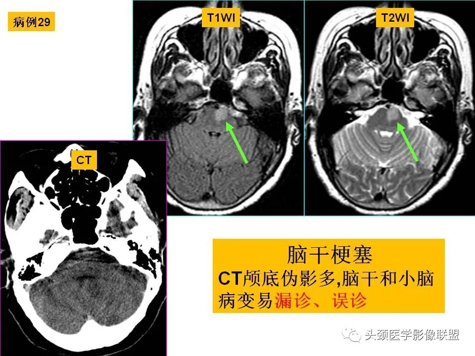 影像PPT - 【PPT】颅脑解剖及血管性病变的MRI诊断-94