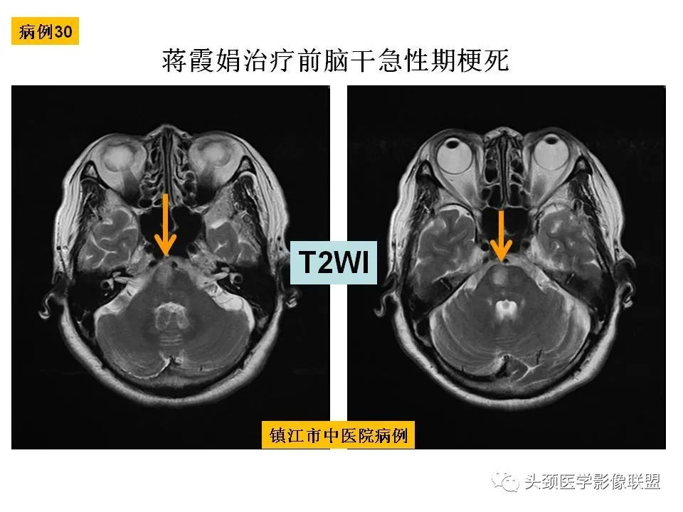影像PPT - 【PPT】颅脑解剖及血管性病变的MRI诊断-95