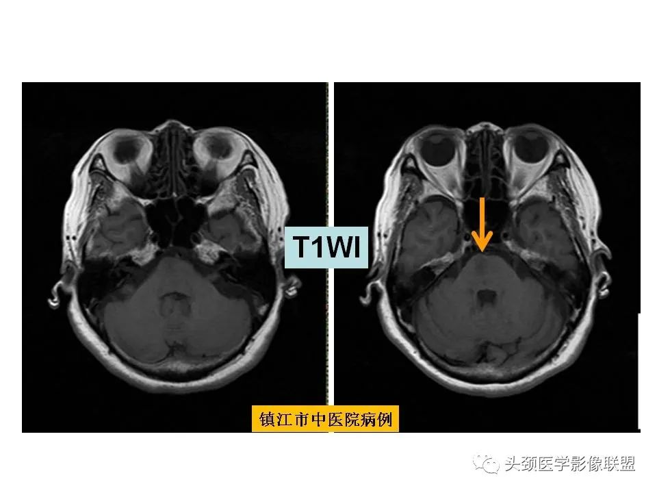 影像PPT - 【PPT】颅脑解剖及血管性病变的MRI诊断-96