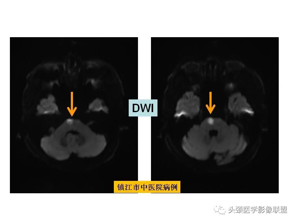 影像PPT - 【PPT】颅脑解剖及血管性病变的MRI诊断-98