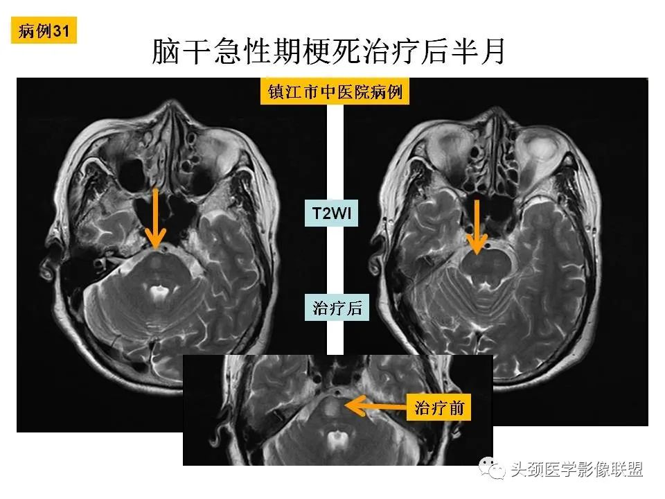 影像PPT - 【PPT】颅脑解剖及血管性病变的MRI诊断-99