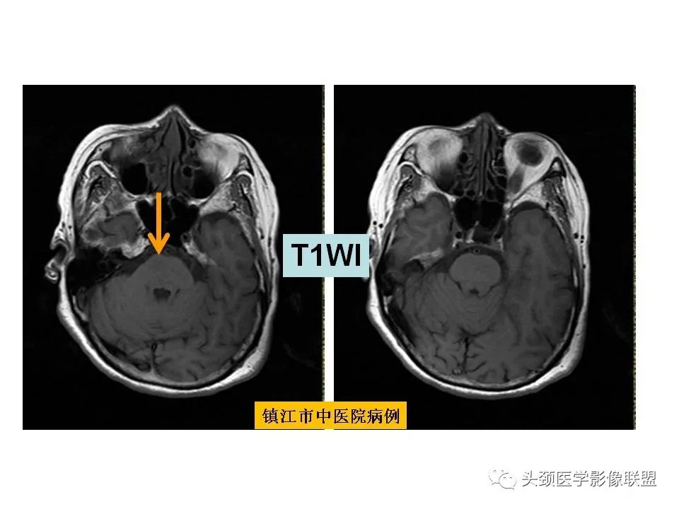 影像PPT - 【PPT】颅脑解剖及血管性病变的MRI诊断-100