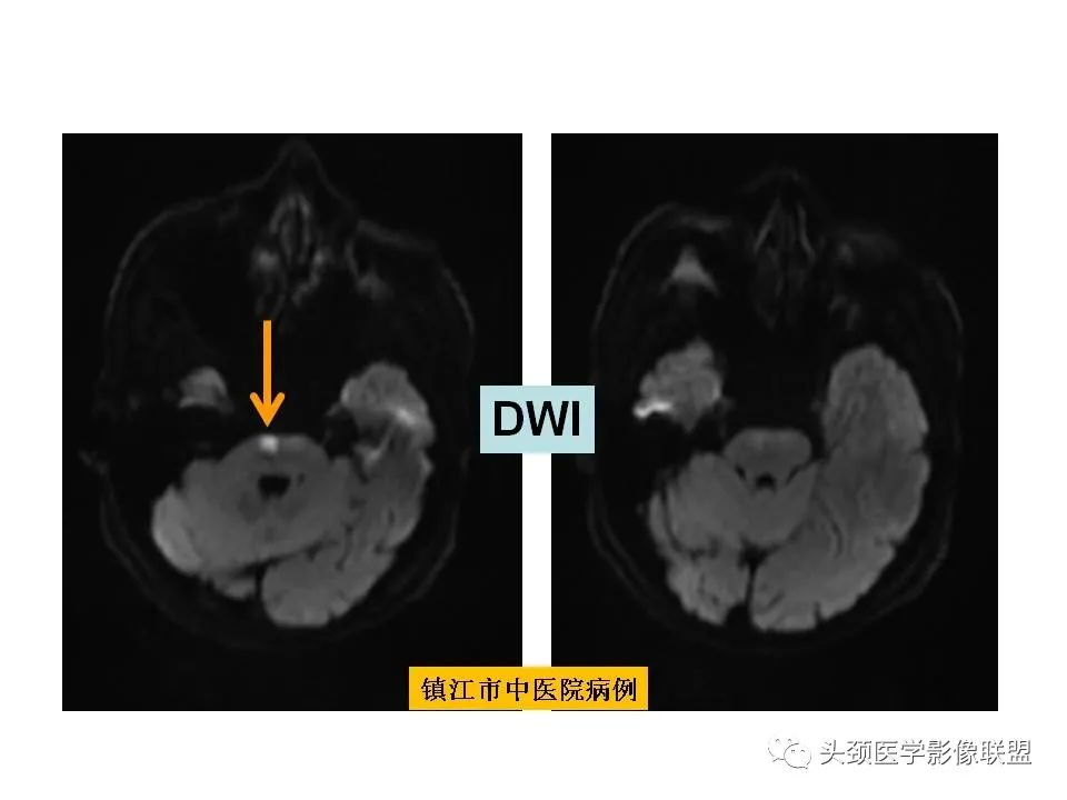 影像PPT - 【PPT】颅脑解剖及血管性病变的MRI诊断-102