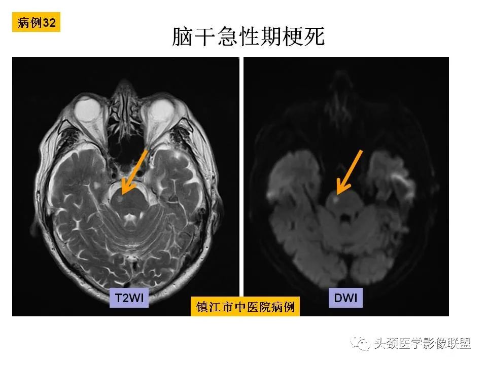 影像PPT - 【PPT】颅脑解剖及血管性病变的MRI诊断-103