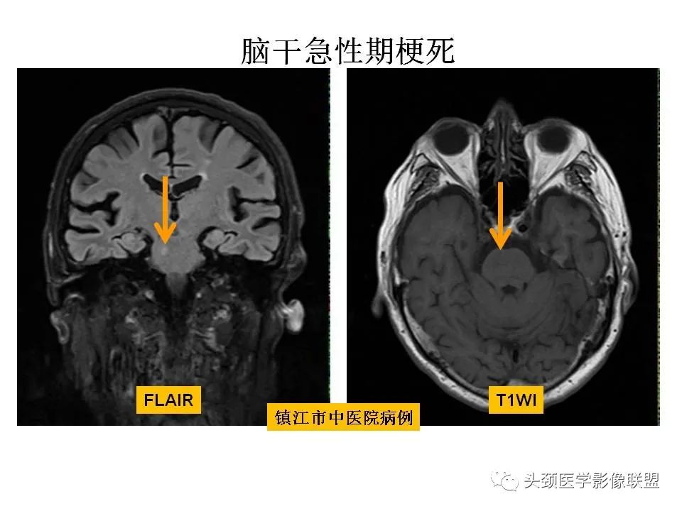 影像PPT - 【PPT】颅脑解剖及血管性病变的MRI诊断-104