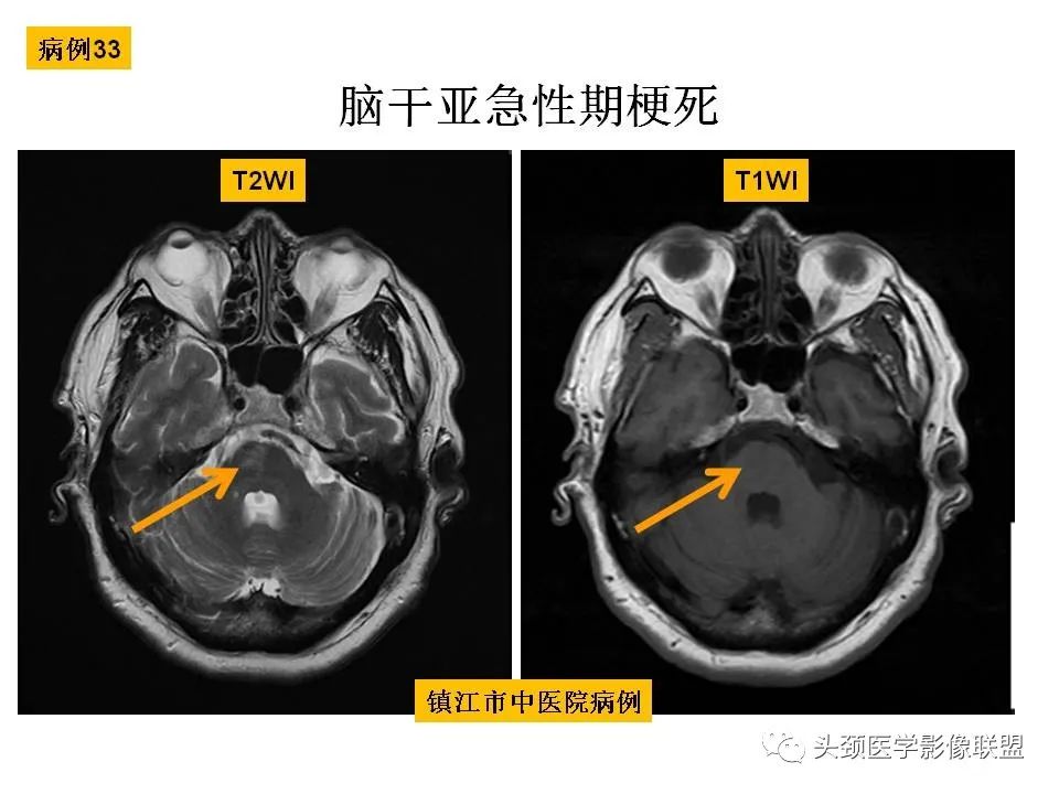 影像PPT - 【PPT】颅脑解剖及血管性病变的MRI诊断-105