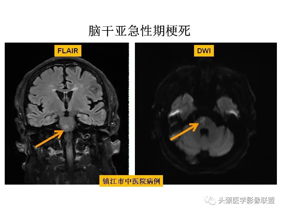 影像PPT - 【PPT】颅脑解剖及血管性病变的MRI诊断-106