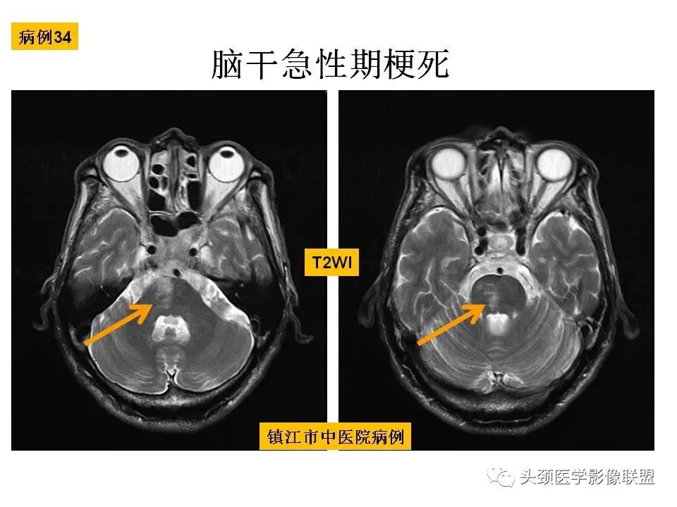 影像PPT - 【PPT】颅脑解剖及血管性病变的MRI诊断-107