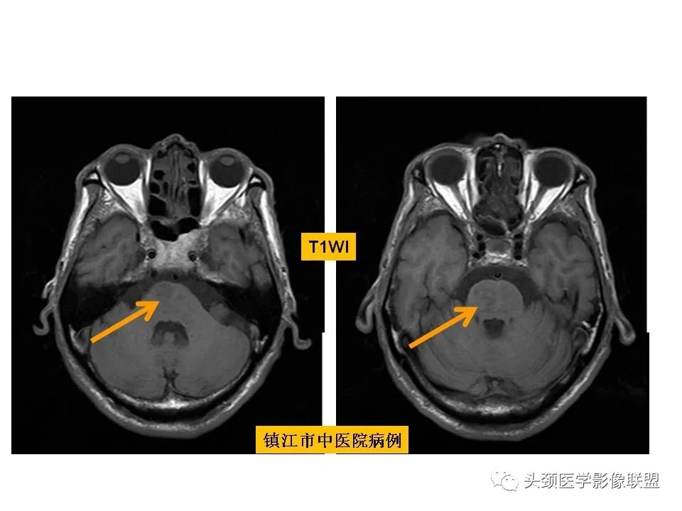 影像PPT - 【PPT】颅脑解剖及血管性病变的MRI诊断-108
