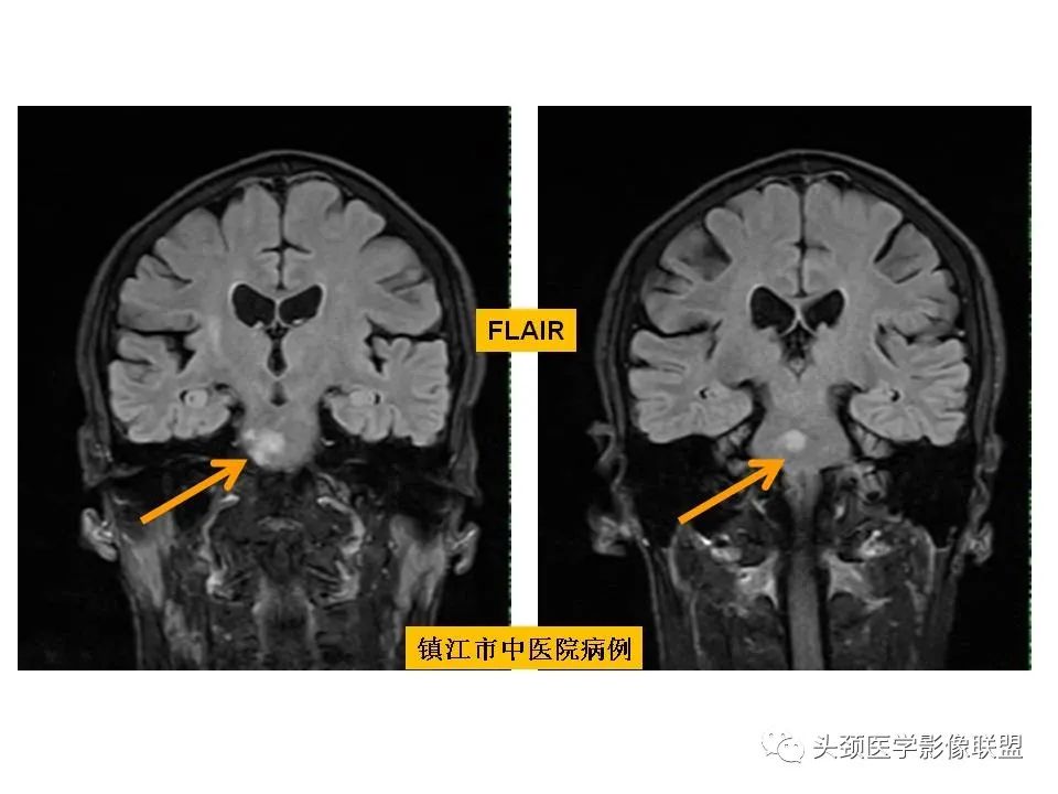 影像PPT - 【PPT】颅脑解剖及血管性病变的MRI诊断-109