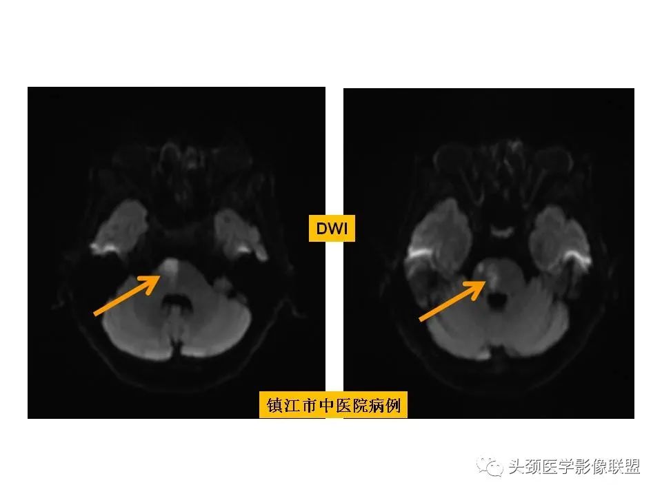 影像PPT - 【PPT】颅脑解剖及血管性病变的MRI诊断-110