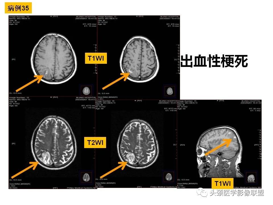 影像PPT - 【PPT】颅脑解剖及血管性病变的MRI诊断-113