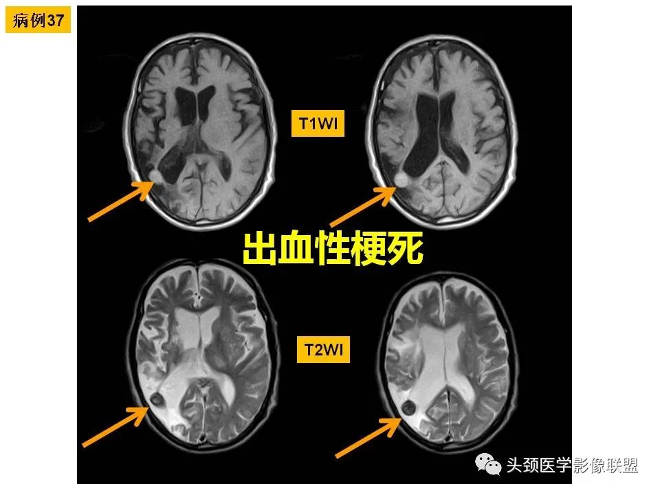 影像PPT - 【PPT】颅脑解剖及血管性病变的MRI诊断-115