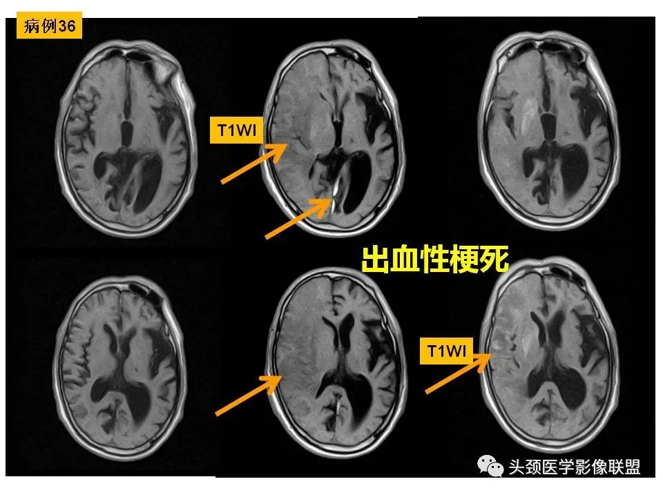 影像PPT - 【PPT】颅脑解剖及血管性病变的MRI诊断-114