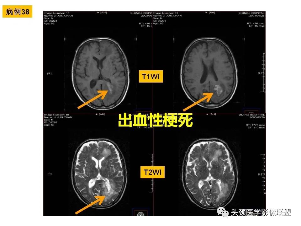 影像PPT - 【PPT】颅脑解剖及血管性病变的MRI诊断-116