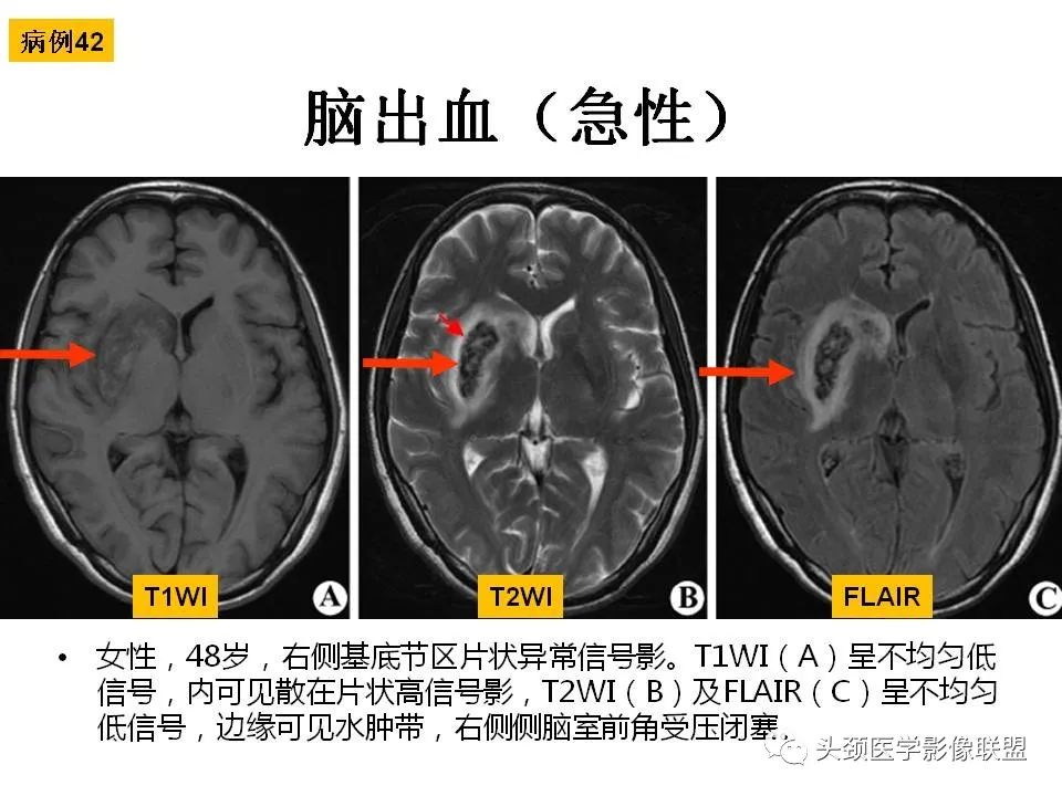 影像PPT - 【PPT】颅脑解剖及血管性病变的MRI诊断-129