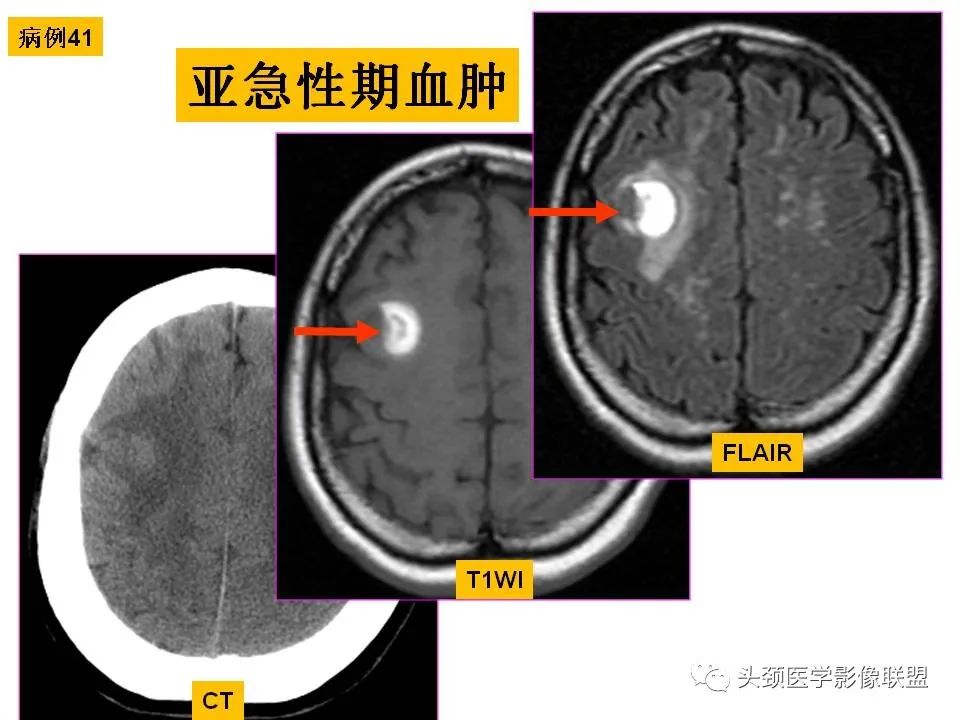 影像PPT - 【PPT】颅脑解剖及血管性病变的MRI诊断-128