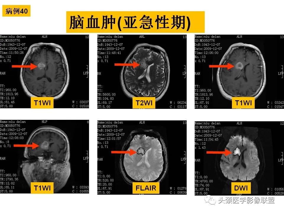 影像PPT - 【PPT】颅脑解剖及血管性病变的MRI诊断-127