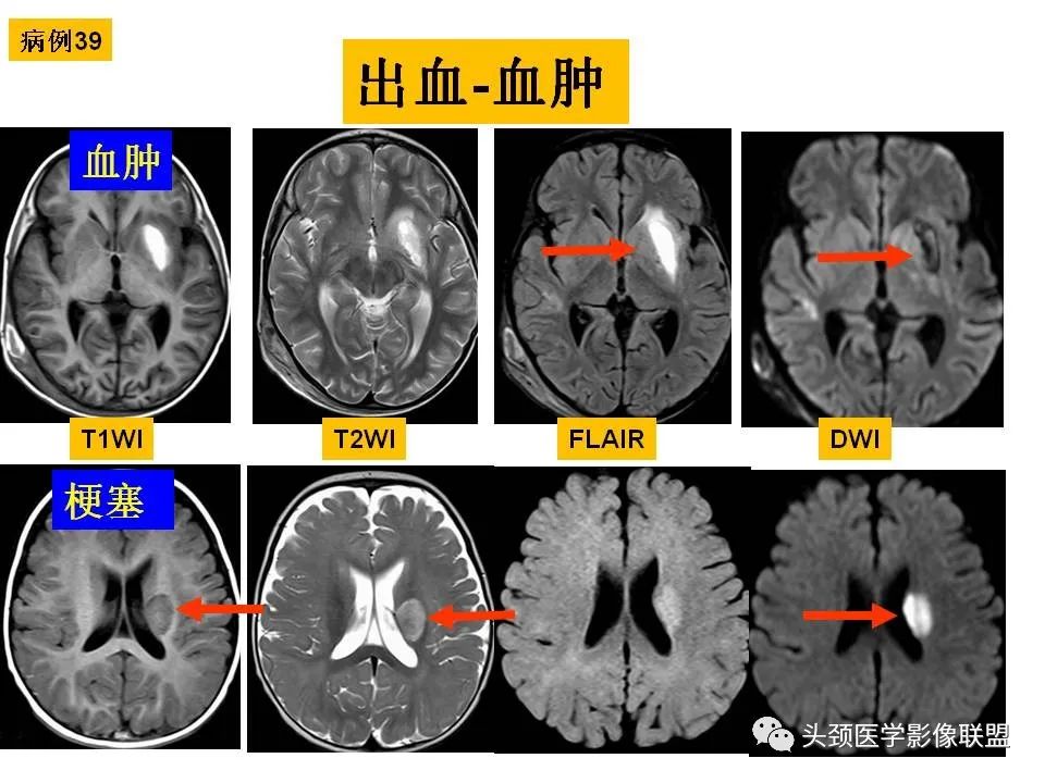 影像PPT - 【PPT】颅脑解剖及血管性病变的MRI诊断-126