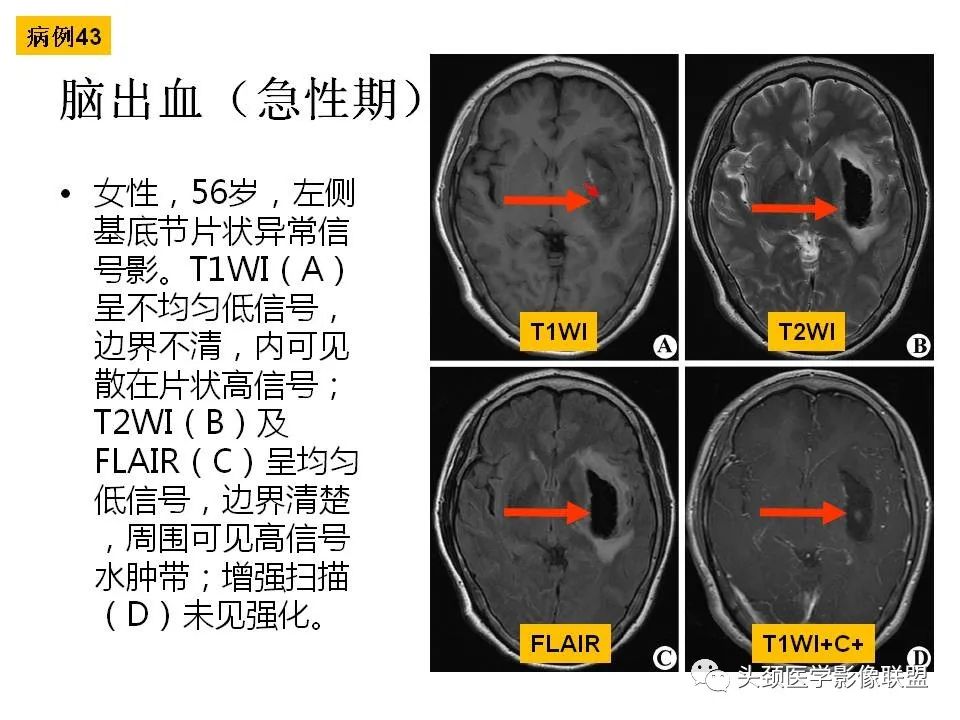 影像PPT - 【PPT】颅脑解剖及血管性病变的MRI诊断-130